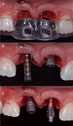 معایب و مزایای ایمپلنتفوری دندان