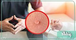 روش های شناخت بهترین دکتر زگیل تناسلی در تهران