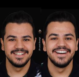 هزینه لمینت کامل دندان