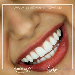 ترمیم رنگ دندان ها