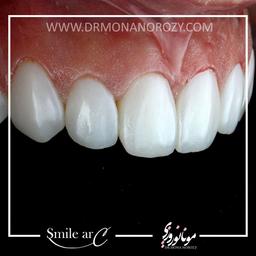 کامپوزیت ونیر دندان