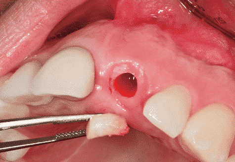 پانچ لثه برای ایمپلنت بدون جراحی