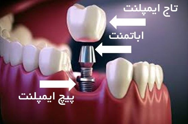 بهترین متخصص ایمپلنت دندان؛ راهنمای جامع انتخاب دندانپزشک ماهر