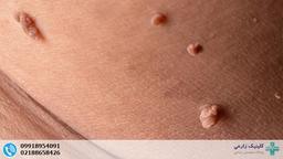 اسکین تگ تناسلی چیست؟ تفاوت با زگیل تناسلی