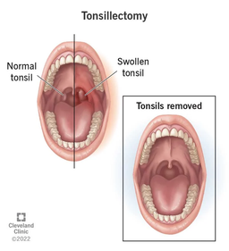 برداشتن لوزه