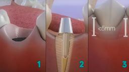 روش‌های جراحی لبخند لثه‌ای (Gummy Smile Surgery)