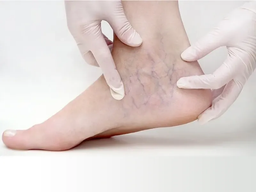 درمان واریس پا: راهنمای جامع برای بیماران