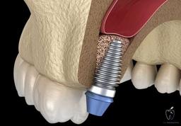 پیوند استخوان در دندانپزشکی