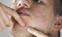 درمان لک و جوش صورت با مراجعه به دکتر پوست خوب