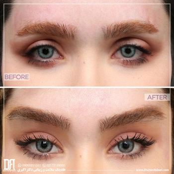 کانتوپلاستی کلینیک دکتر اکبری