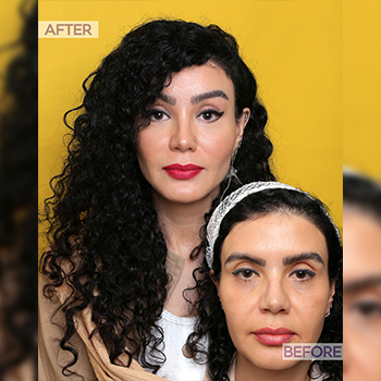 لیفت گونه کلینیک دکتر اکبری