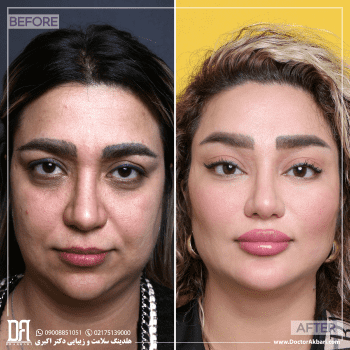 جراحی ترکیبی با جدیدترین متد جوانسازی در کلینیک دکتر اکبری