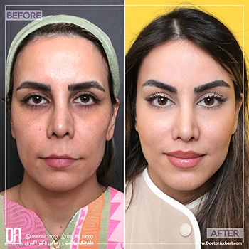 لیفت شقیقه کلینیک دکتر اکبری