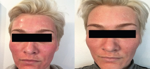 میکرونیدلینگ صورت