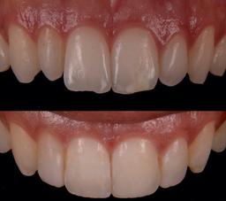 کامپوزیت دندان چیست؟ چه مدت دوام دارد؟