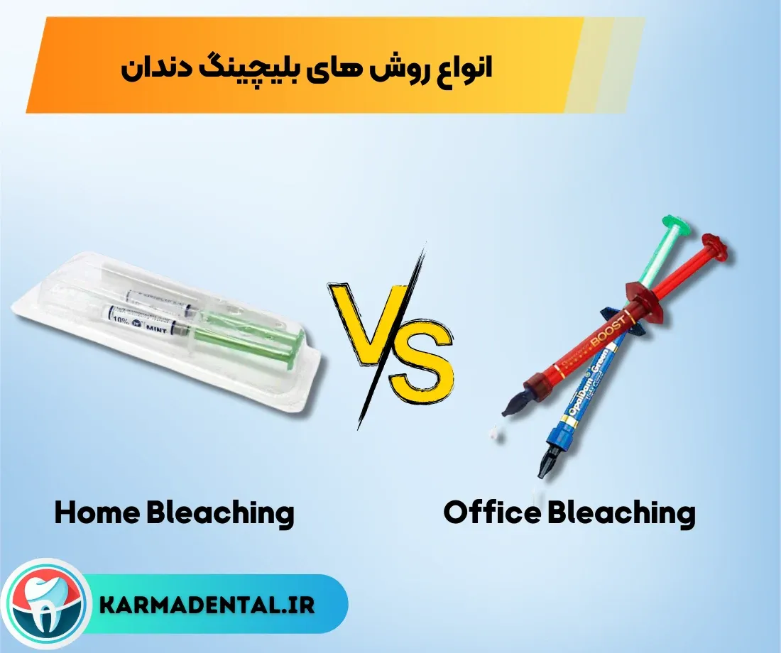 انواع روش های بلیچینگ دندان - هوم بلیچینگ - آفیس بلیچینگ