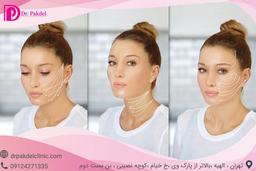 لیفت صورت face lift چیست؟انواع روش های لیفت کامل صورت
