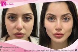 لیفت شقیقه چگونه انجام می شود؟انواع روش ها,مزایا,مراقبتها