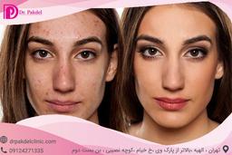 میکرودرم microdermabrasion چیست؟روش انجام کار,مزایا