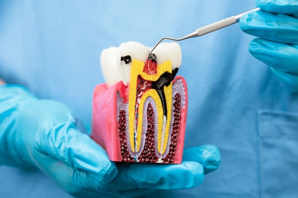 درد عصب کشی دندان چقدر طول می کشد