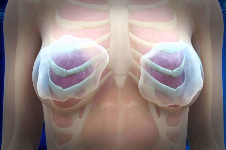 عوارض احتمالی پروتز سینه