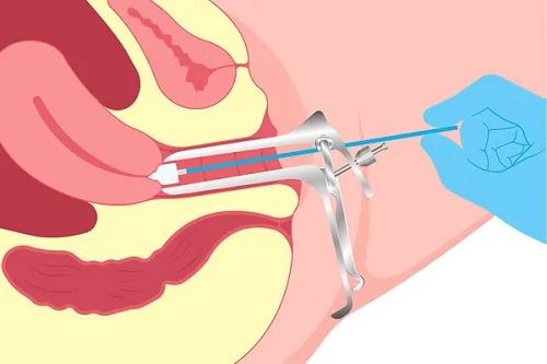 آیا پاپ اسمیر در پریودی ممکن است؟