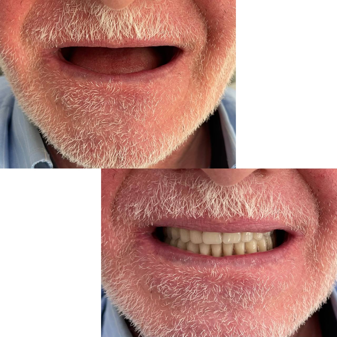 انواع دندان مصنوعی ژاپنی