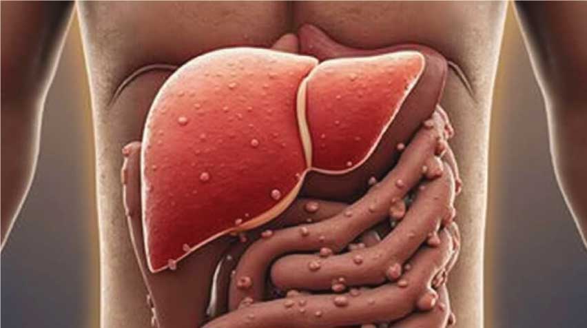 همه چیز درباره کبد چرب