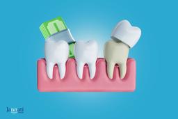 قیمت لمینت دندان و عوامل موثر بر آن (بهترین قیمت و کیفیت)