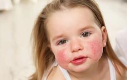 اگزما: علل، انواع و روش‌های درمان