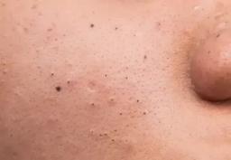 جوش‌ سرسیاه چیست؟