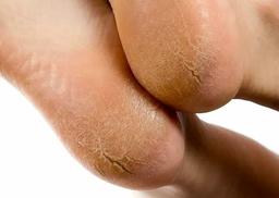 دلایل ترک پا و روش‌ های درمان آن