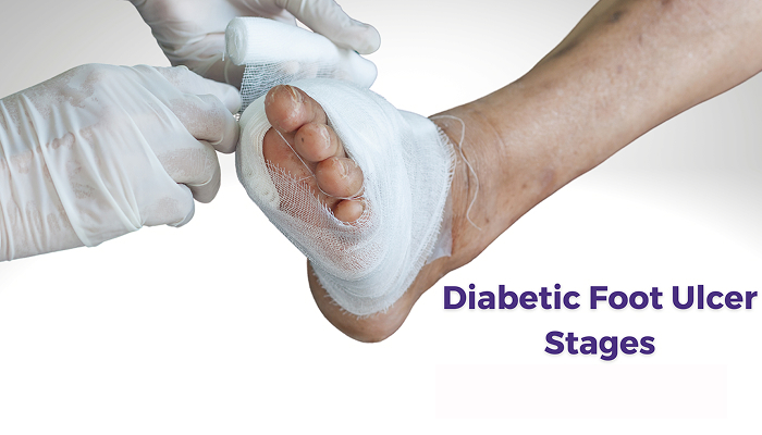 مراحل درمان زخم پای دیابتی