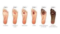 9 عادتی که شما را در معرض خطر زخم دیابتی قرار می‌دهد!