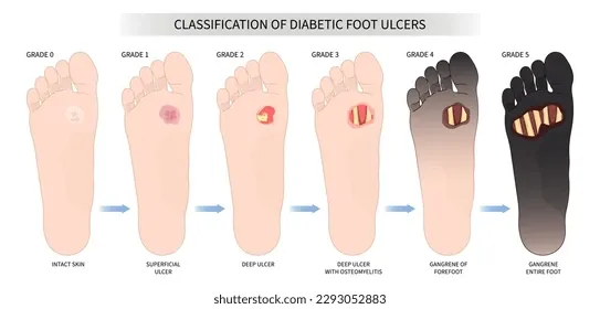 درجه بندی زخم دیابتی