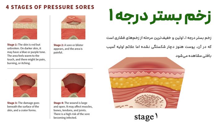 زخم بستر درجه 1