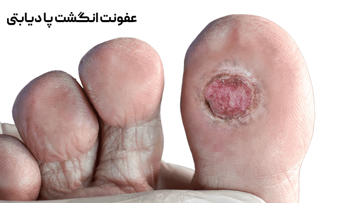 درمان عفونت زخم پای دیابتی