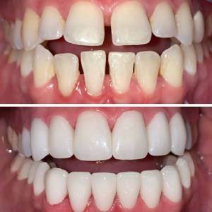 تصاویر لمینت دندان