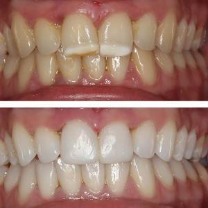 تصاویر لمینت دندان