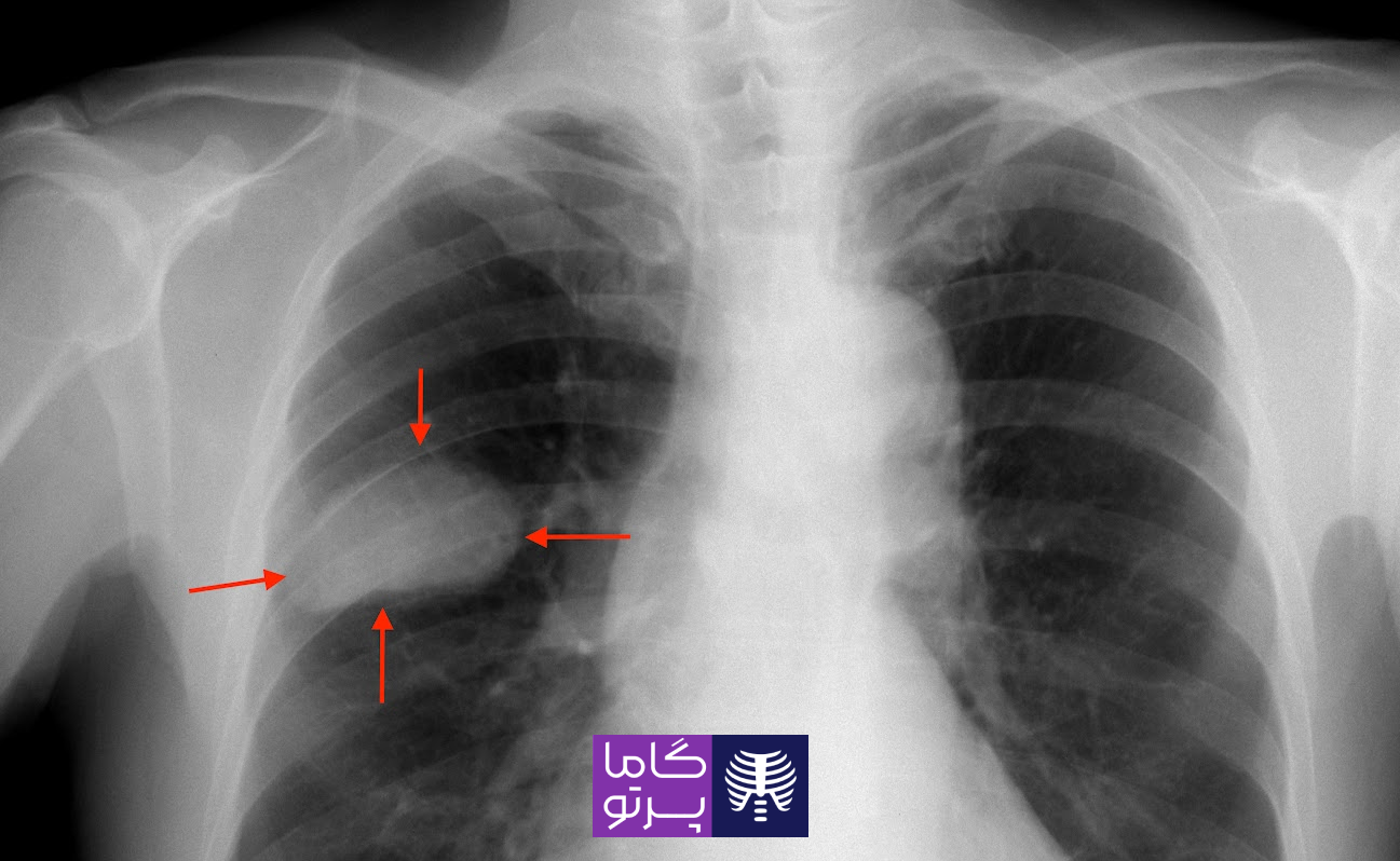 تصاویر رادیولوژی از سرطان ریه: نمونههایی از نتایج - گاما پرتو - مرکز رادیولوژی در منزل