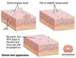 محدودیت رابطه جنسی بعد از درمان زگیل تناسلی