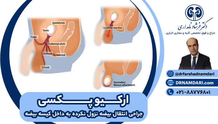 عمل بیضه نزول نکرده یا ارکیدوپکسی 