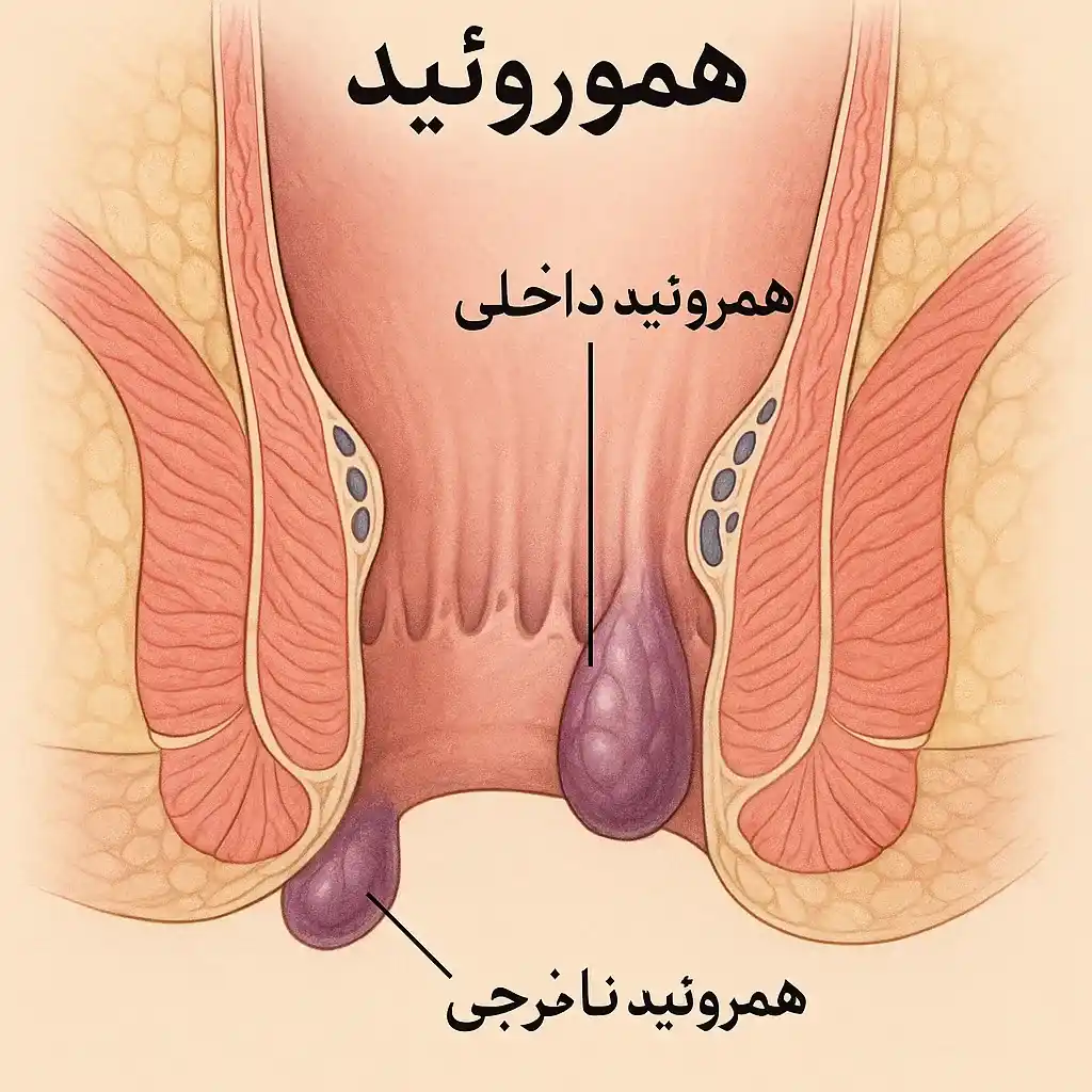هموروئید
