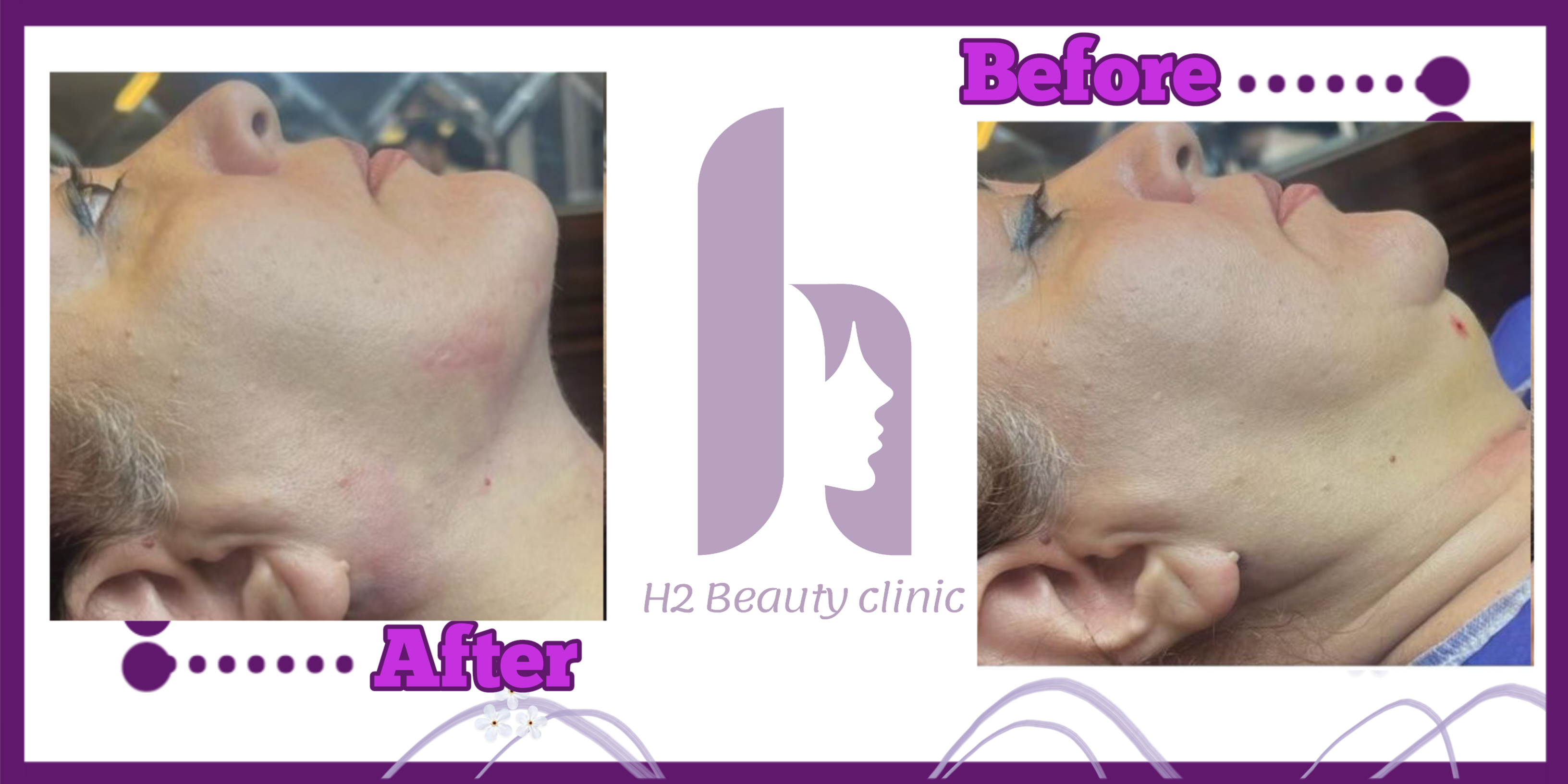 نمونه کار ساکشن غبغب از کلینیک اچ تو