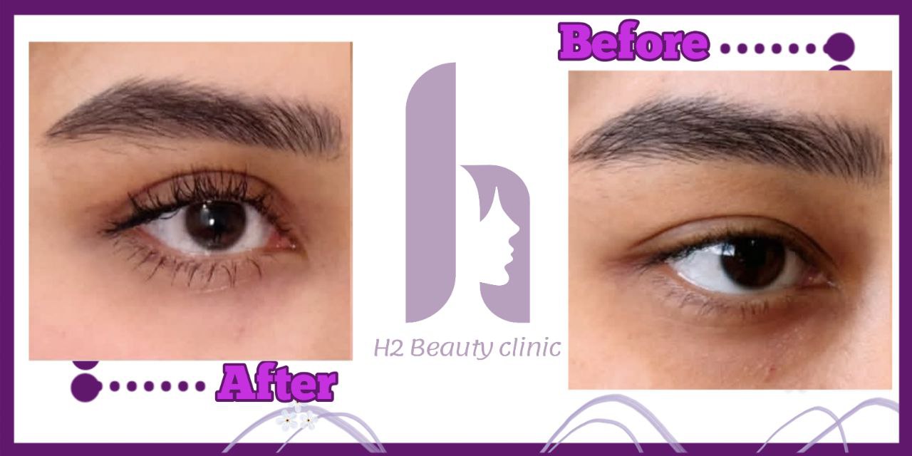 نمونه کار بلفاروپلاستی از کلینیک اچ تو