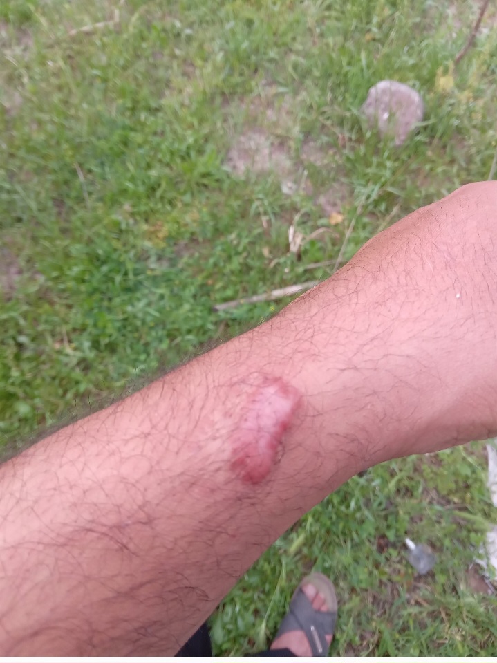 گوشت اضافی روی دست