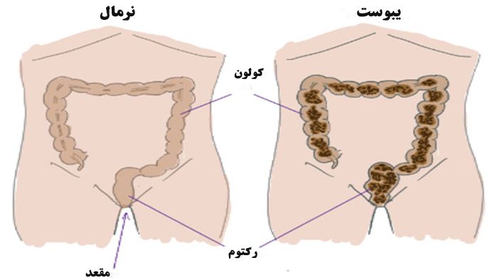 داروهای درمان یبوست