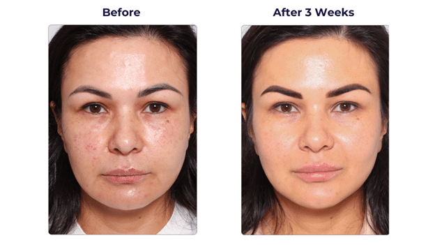 تاثیر پروفایلو بعد از سه هفته