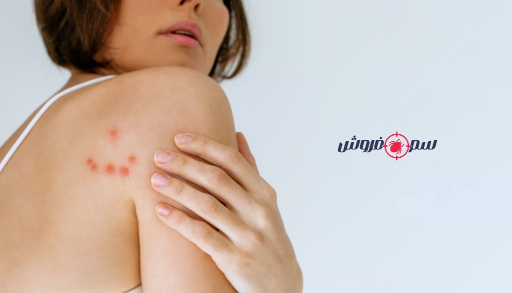 نیش ساس در بدن یک زن