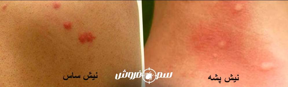 تفاوت نیش ساس با نیش پشه